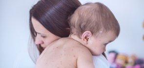 Uma mulher segurando um bebe no colo. O bebe está sem blusa e dá para ver diversas bolinhas vermelhas em sua pele